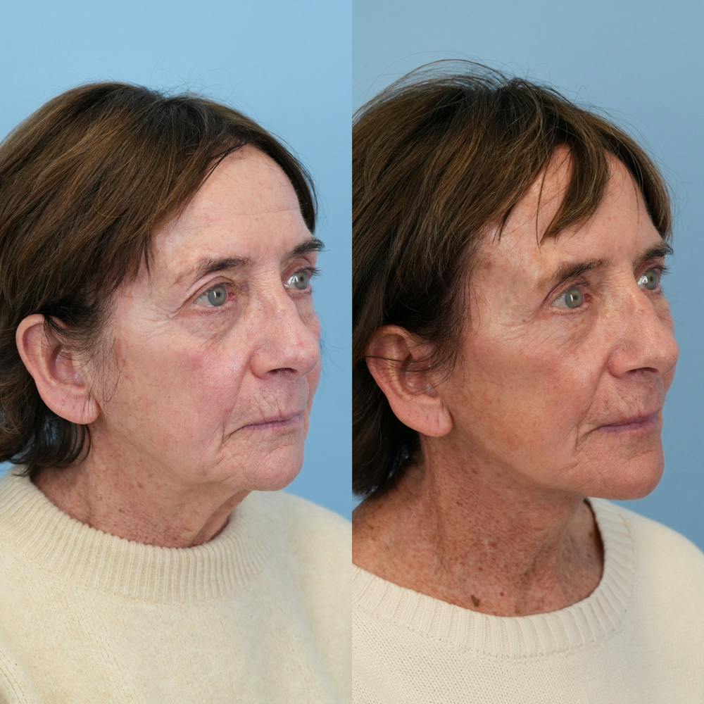 Facelift Before & After Gallery - Patient 117675 - Image 3
