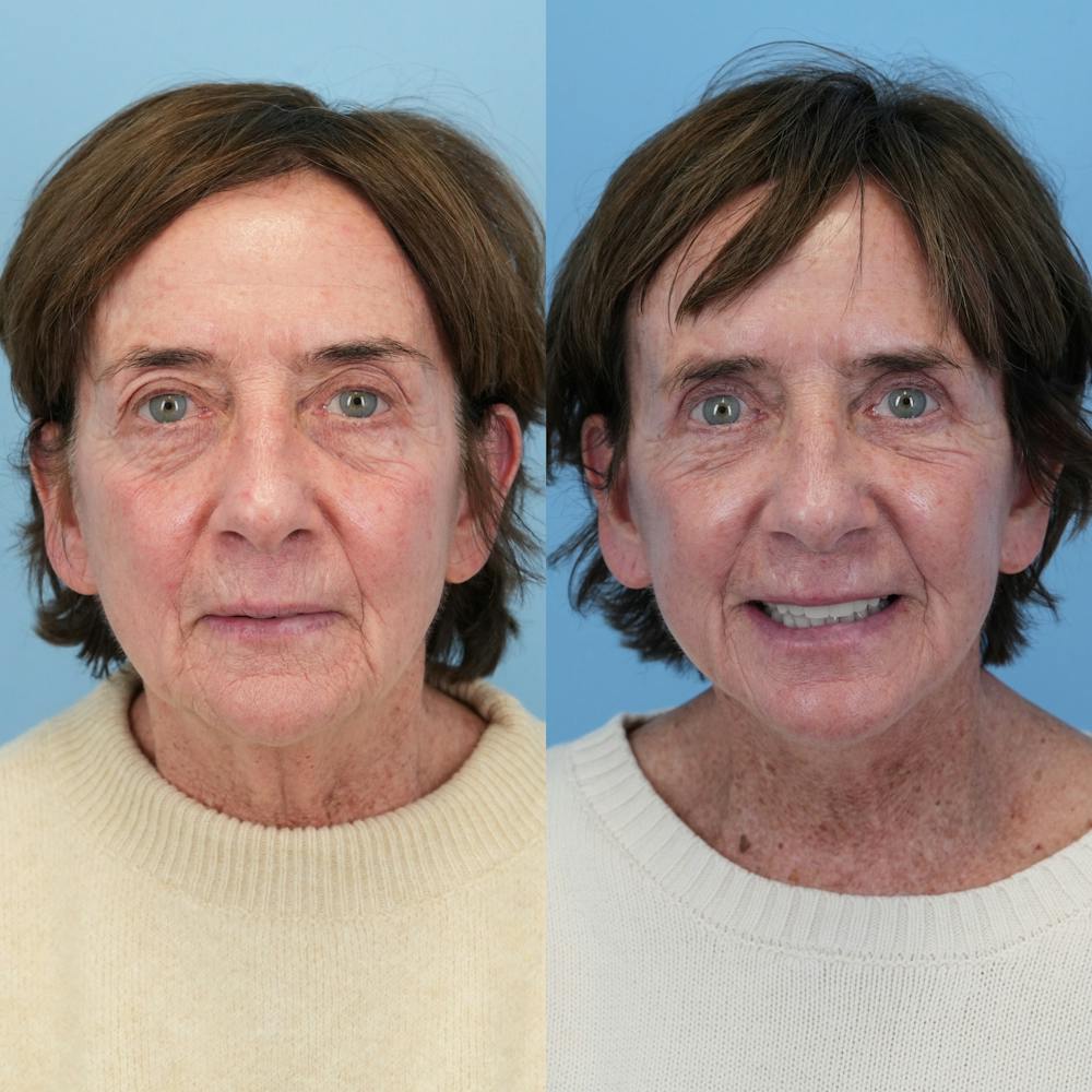 Facelift Before & After Gallery - Patient 117675 - Image 1