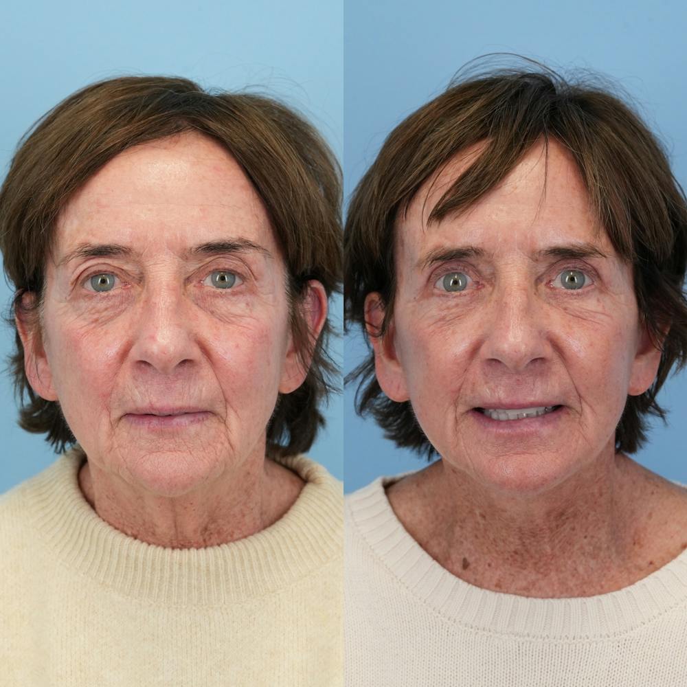 Facelift Before & After Gallery - Patient 117675 - Image 2