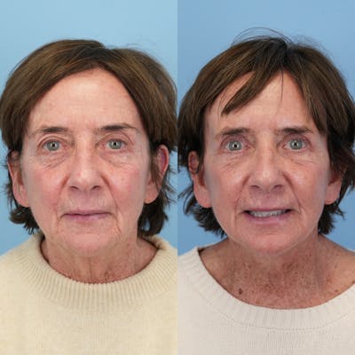 Facelift Before & After Gallery - Patient 117675 - Image 2