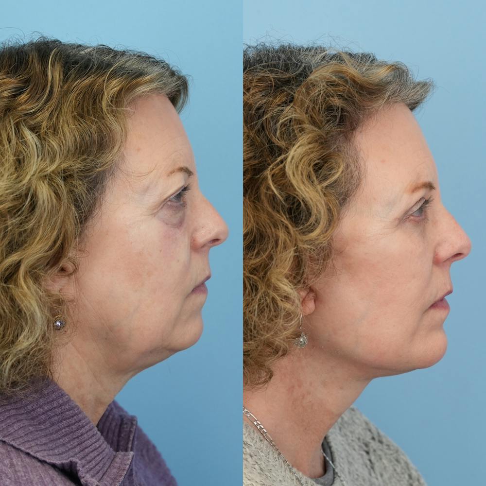 Chin Implants Before & After Gallery - Patient 253618 - Image 5