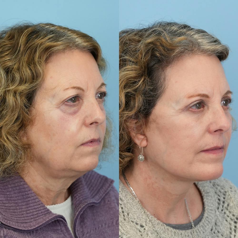 Chin Implants Before & After Gallery - Patient 253618 - Image 4