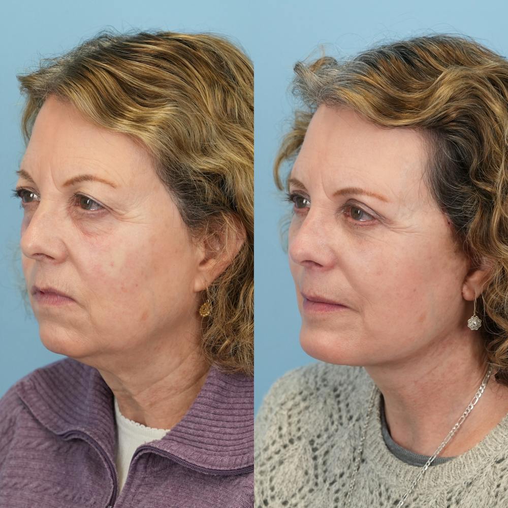 Chin Implants Before & After Gallery - Patient 253618 - Image 2