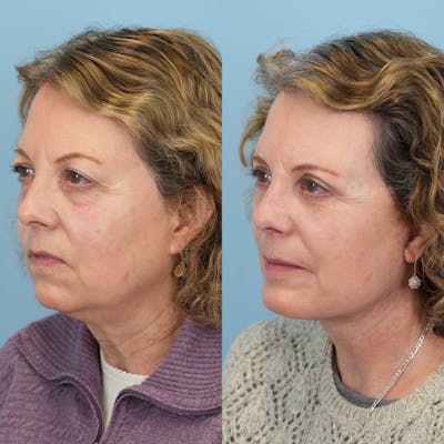 Chin Implants Before & After Gallery - Patient 253618 - Image 2