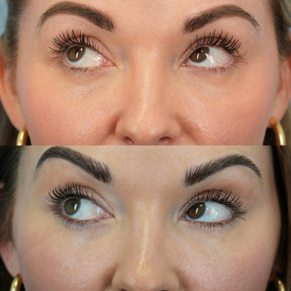 Fat Grafting Before & After Gallery - Patient 258883 - Image 5