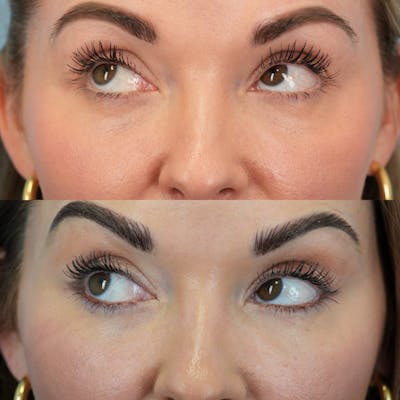Lower Eyelids Before & After Gallery - Patient 141424 - Image 4