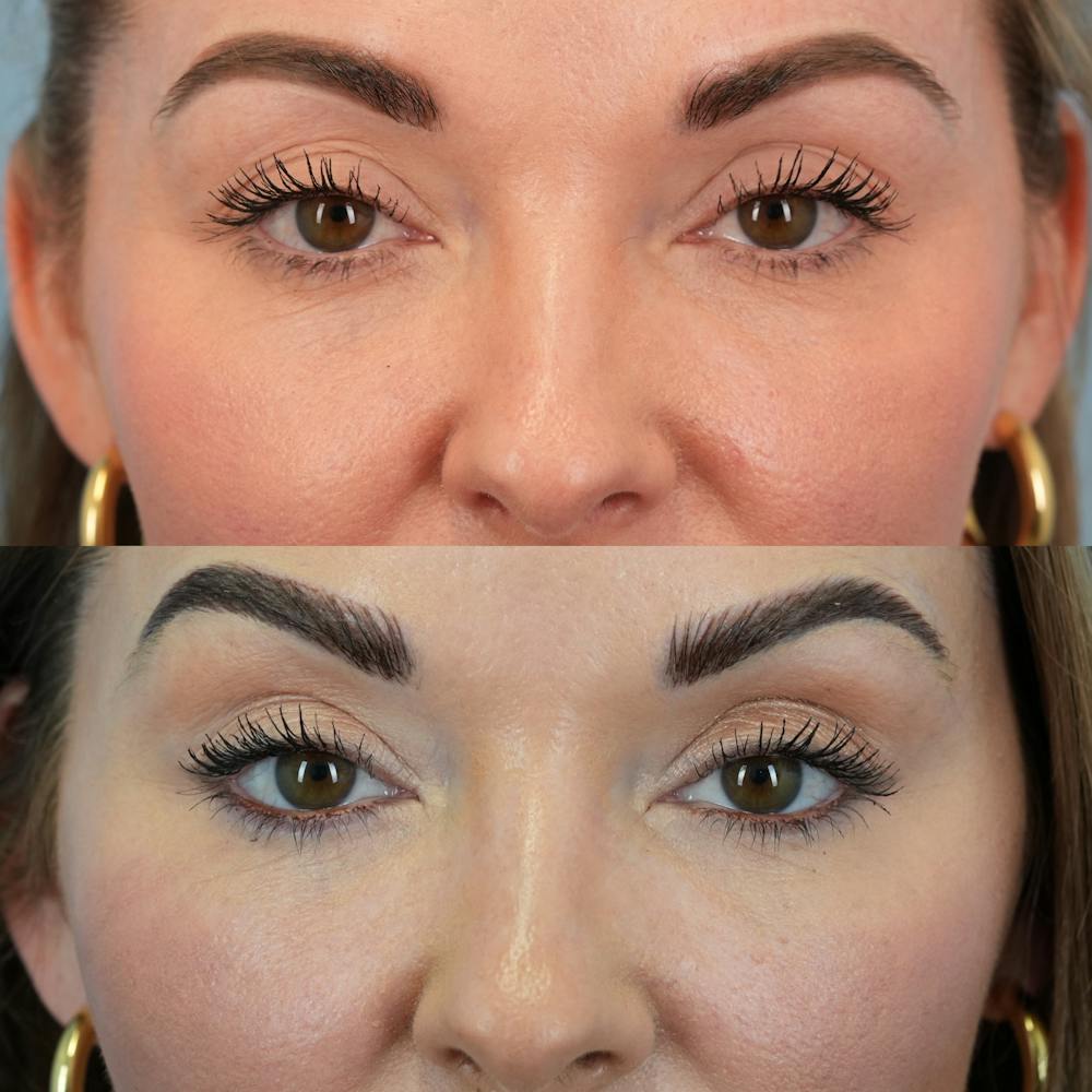 Fat Grafting Before & After Gallery - Patient 258883 - Image 2