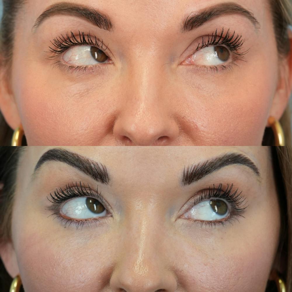 Fat Grafting Before & After Gallery - Patient 258883 - Image 4