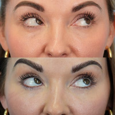 Fat Grafting Before & After Gallery - Patient 258883 - Image 4