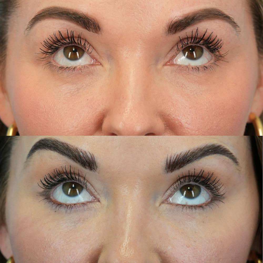 Fat Grafting Before & After Gallery - Patient 258883 - Image 3