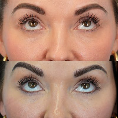 Lower Eyelids Before & After Gallery - Patient 141424 - Image 2