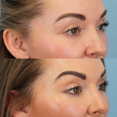 Fat Grafting Before & After Gallery - Patient 258883 - Image 6