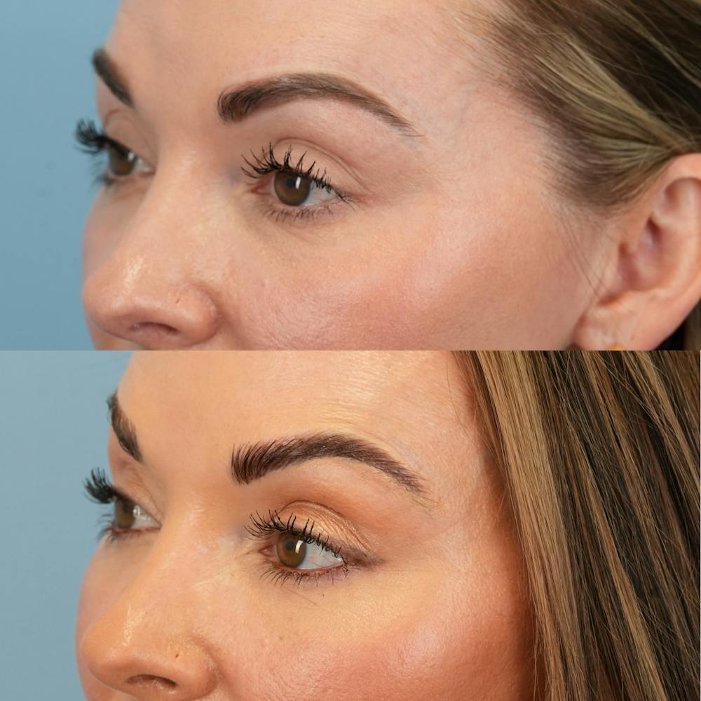 Fat Grafting Before & After Gallery - Patient 258883 - Image 7