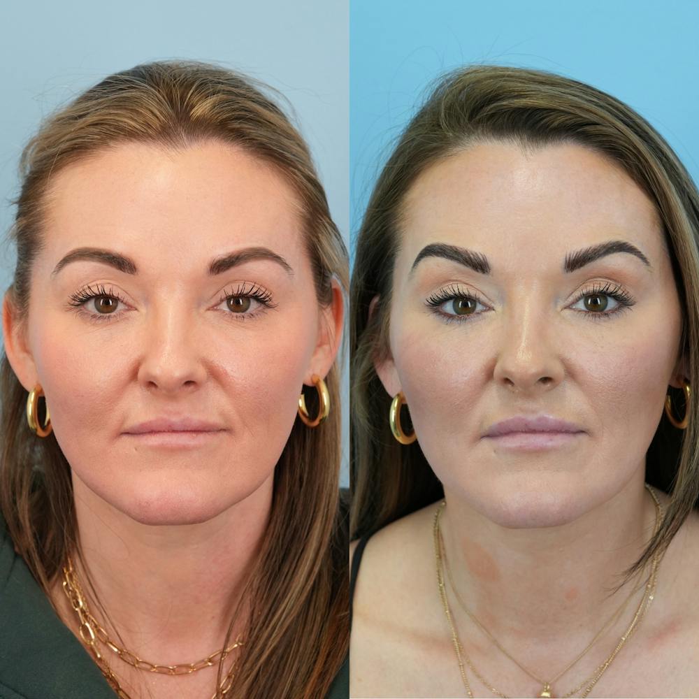 Fat Grafting Before & After Gallery - Patient 258883 - Image 1
