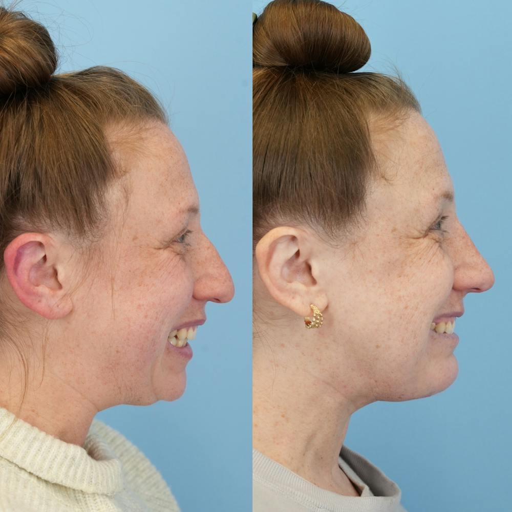 Chin Implants Before & After Gallery - Patient 270513 - Image 6