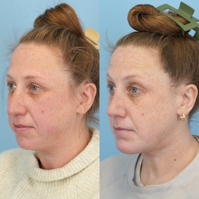 Chin Implants Before & After Gallery - Patient 270513 - Image 2