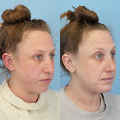 Chin Implants Before & After Gallery - Patient 270513 - Image 4