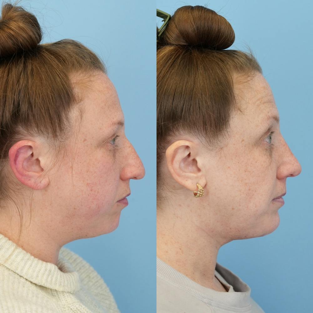 Chin Implants Before & After Gallery - Patient 270513 - Image 5