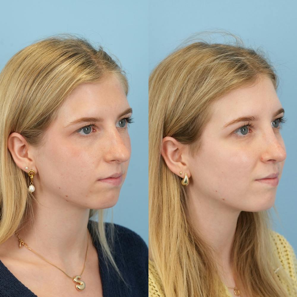 Rhinoplasty Before & After Gallery - Patient 115419 - Image 2