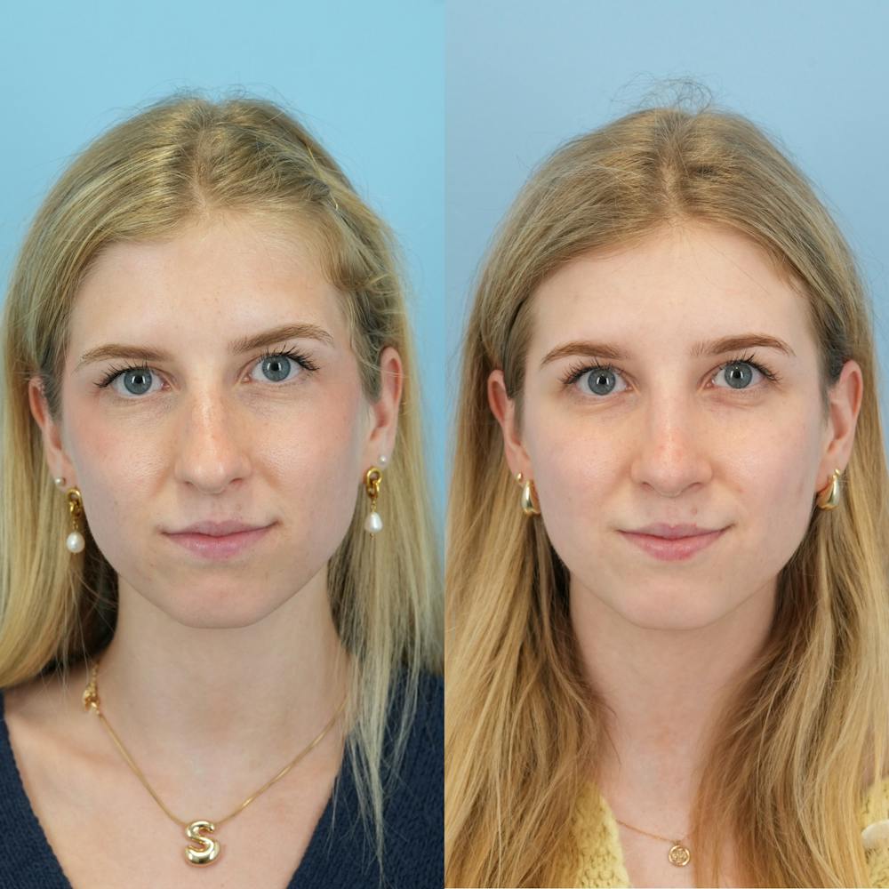 Rhinoplasty Before & After Gallery - Patient 115419 - Image 1