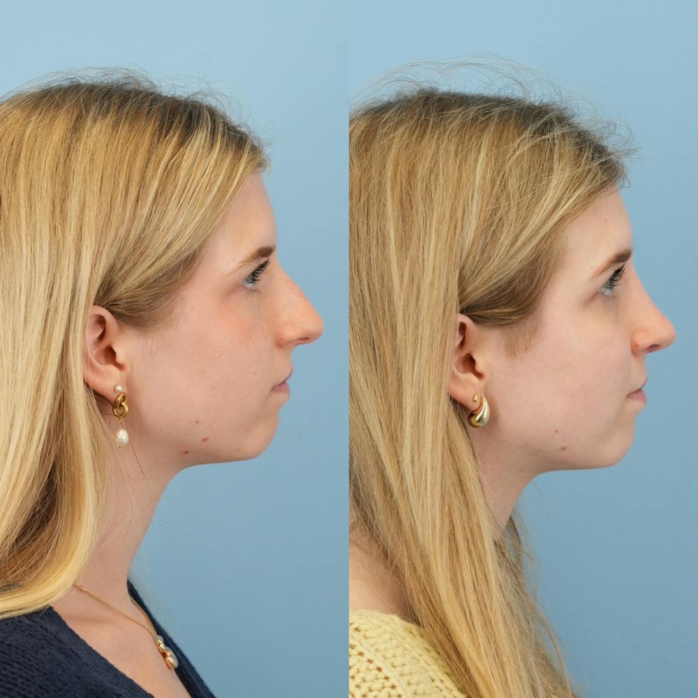 Rhinoplasty Before & After Gallery - Patient 115419 - Image 3