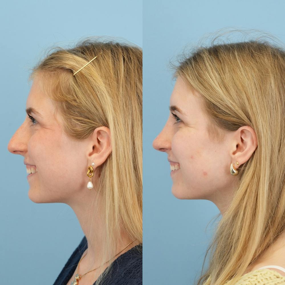 Rhinoplasty Before & After Gallery - Patient 115419 - Image 7