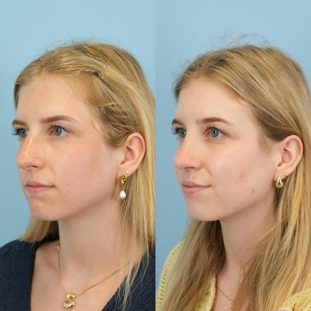 Rhinoplasty Before & After Gallery - Patient 115419 - Image 5