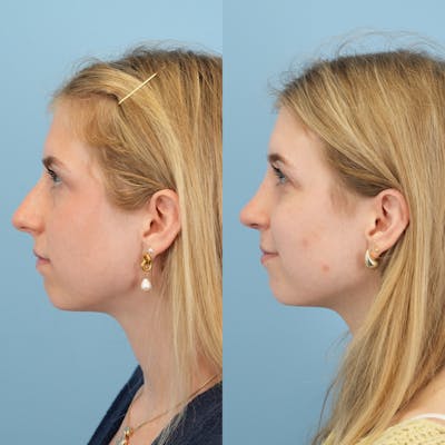 Rhinoplasty Before & After Gallery - Patient 115419 - Image 6