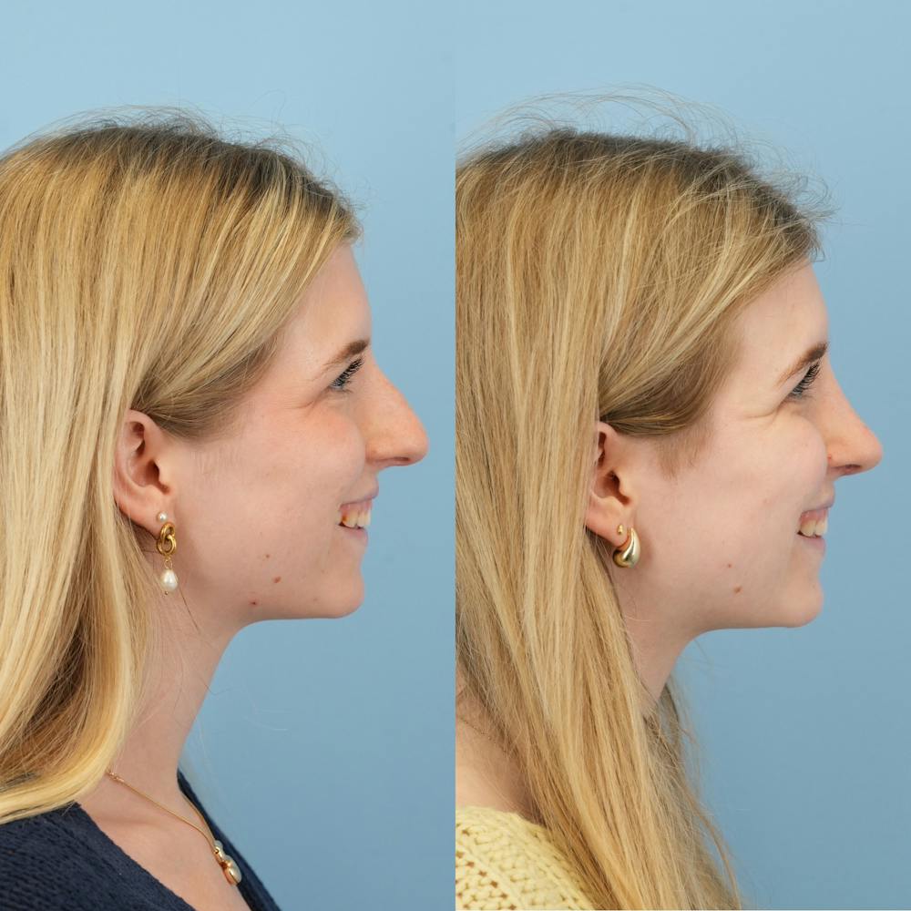 Rhinoplasty Before & After Gallery - Patient 115419 - Image 4