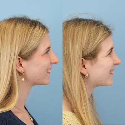 Rhinoplasty Before & After Gallery - Patient 115419 - Image 4