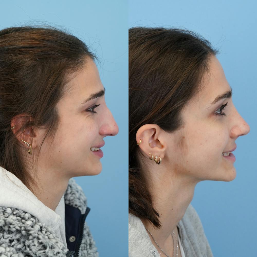 Rhinoplasty Before & After Gallery - Patient 153560 - Image 4