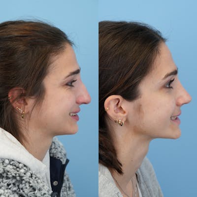 Rhinoplasty Before & After Gallery - Patient 153560 - Image 4