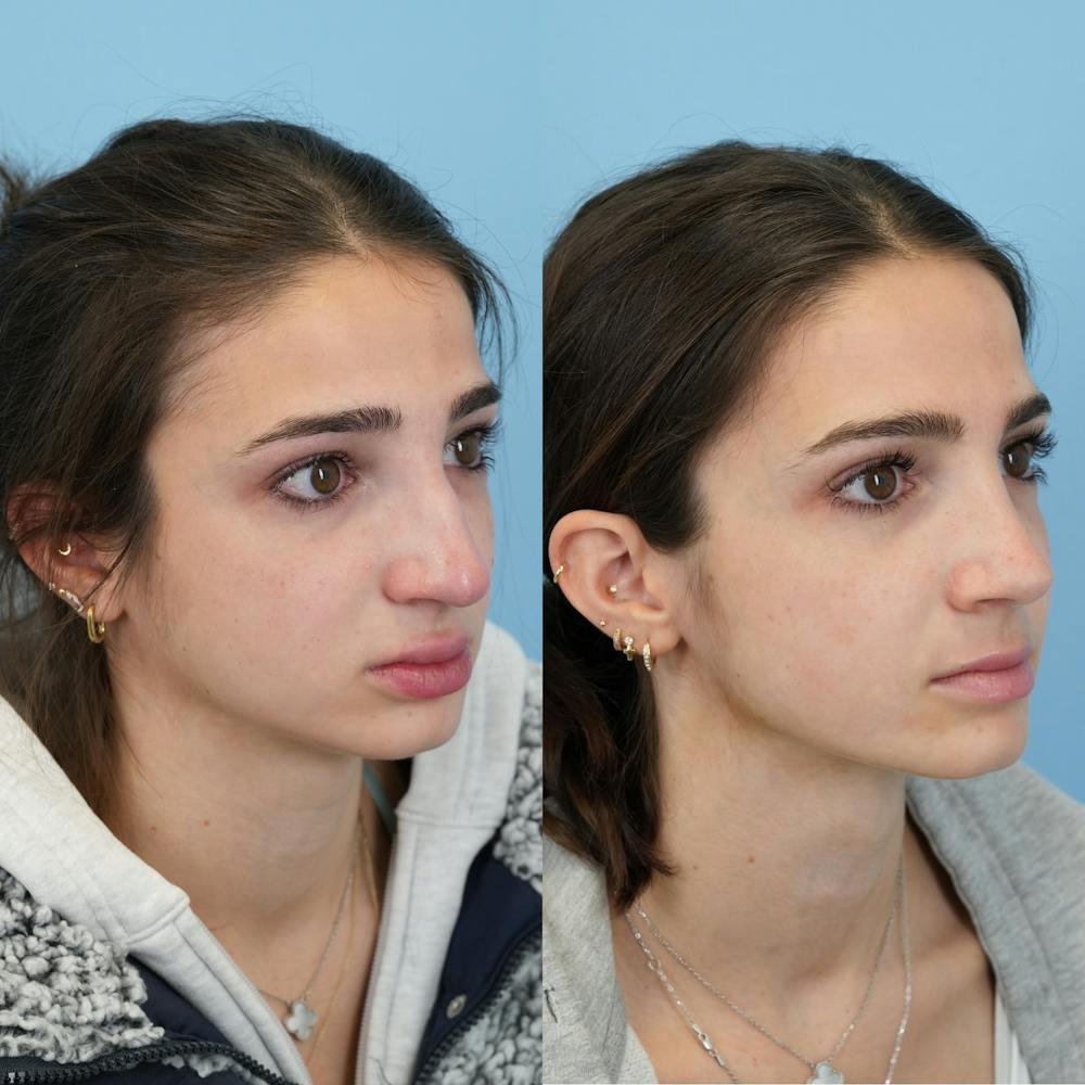 Rhinoplasty Before & After Gallery - Patient 153560 - Image 2
