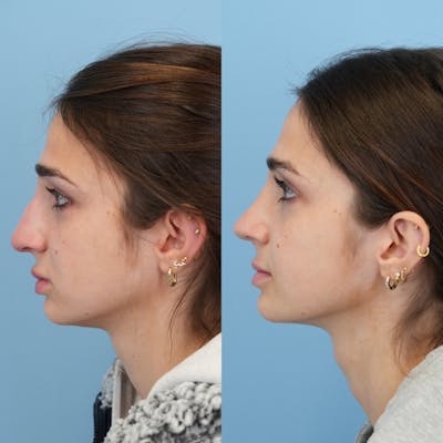Rhinoplasty Before & After Gallery - Patient 153560 - Image 6