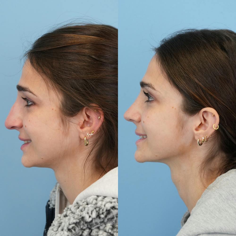 Rhinoplasty Before & After Gallery - Patient 153560 - Image 7