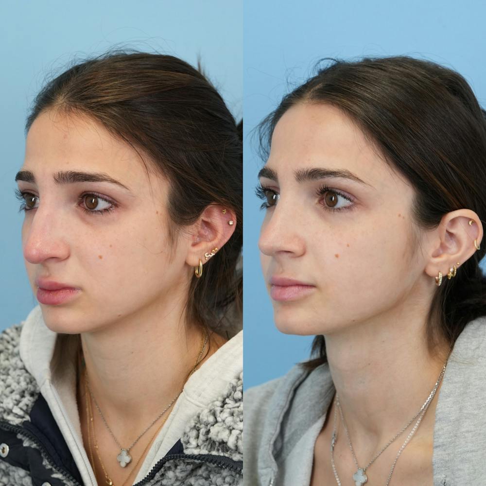 Rhinoplasty Before & After Gallery - Patient 153560 - Image 5