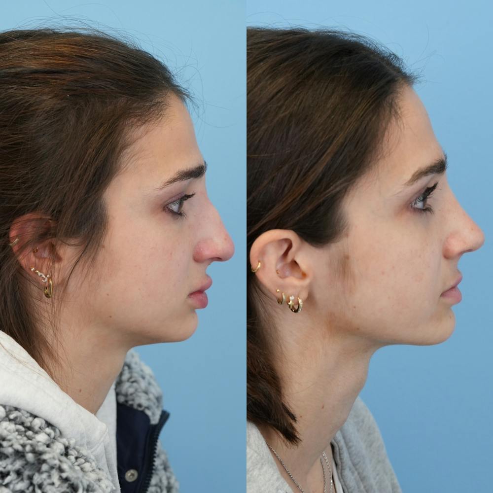 Rhinoplasty Before & After Gallery - Patient 153560 - Image 3