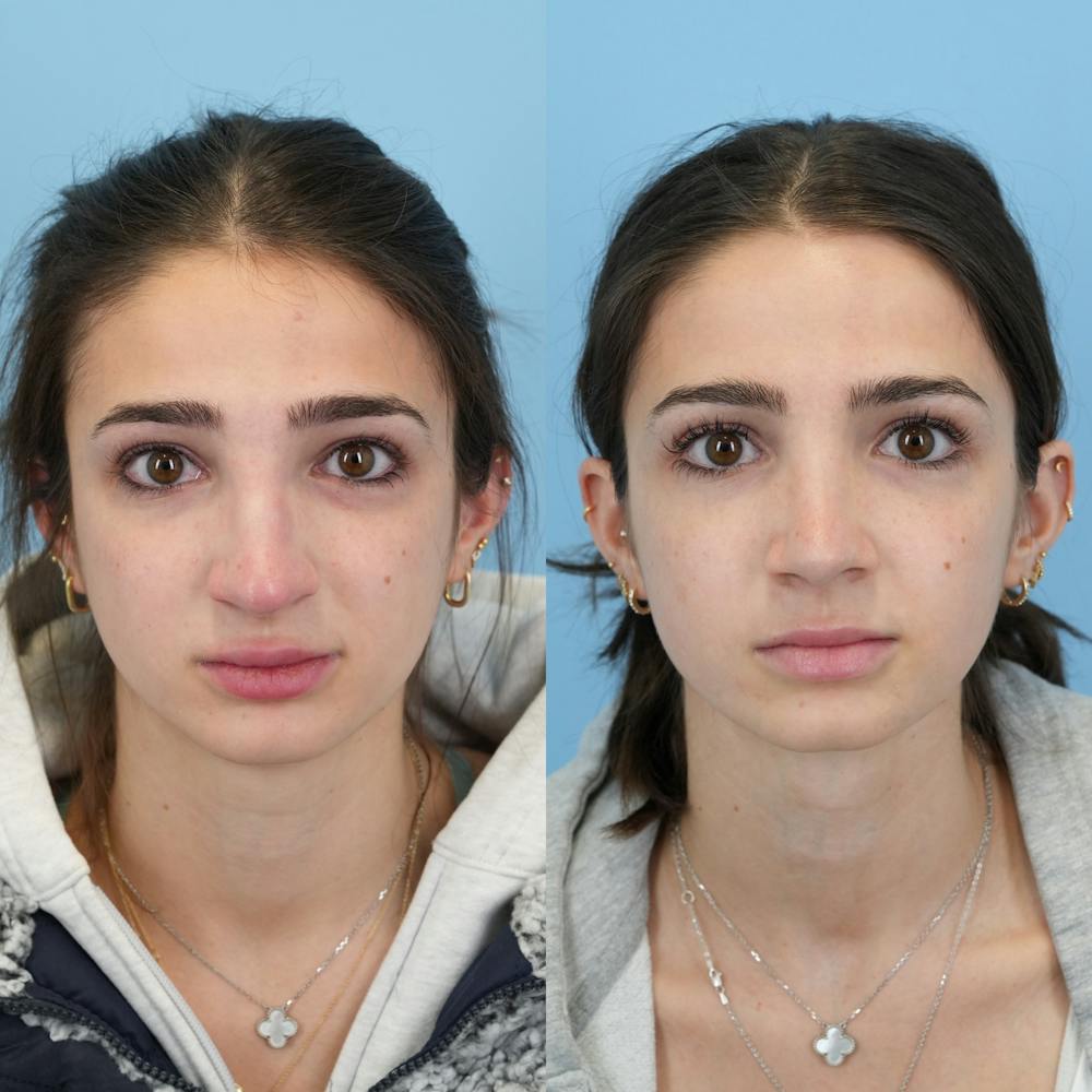 Rhinoplasty Before & After Gallery - Patient 153560 - Image 1