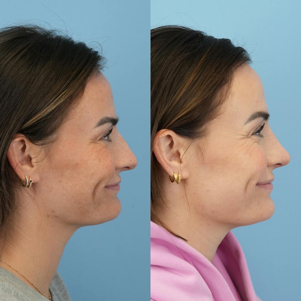 Rhinoplasty Before & After Gallery - Patient 429472 - Image 4
