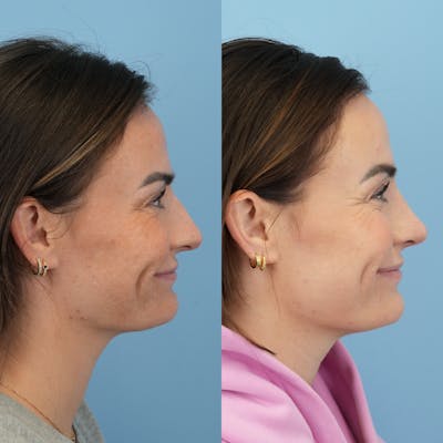Rhinoplasty Before & After Gallery - Patient 429472 - Image 4