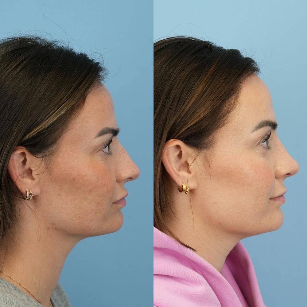 Rhinoplasty Before & After Gallery - Patient 429472 - Image 3