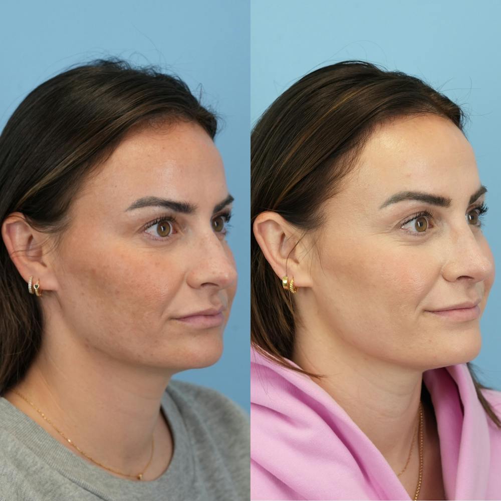 Rhinoplasty Before & After Gallery - Patient 429472 - Image 2