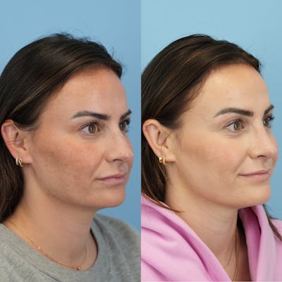 Rhinoplasty Before & After Gallery - Patient 429472 - Image 2