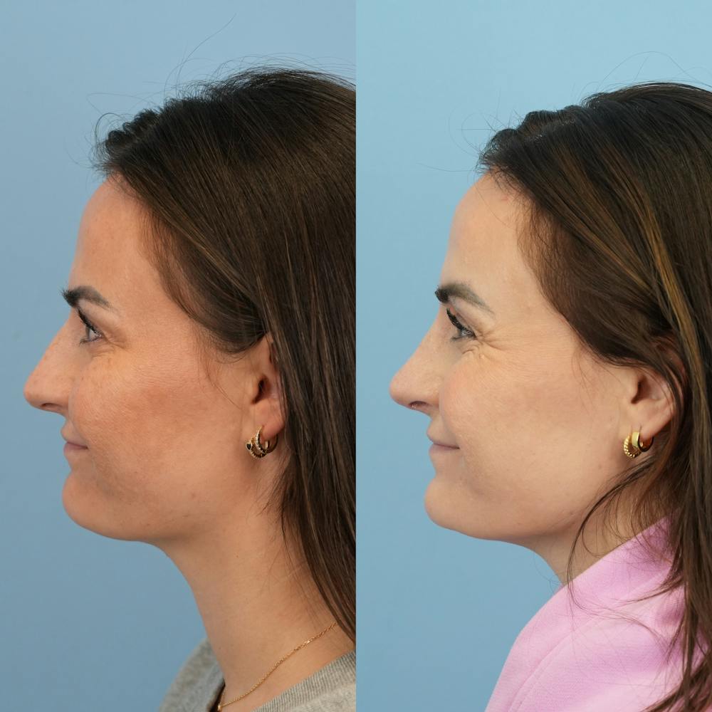 Rhinoplasty Before & After Gallery - Patient 429472 - Image 7