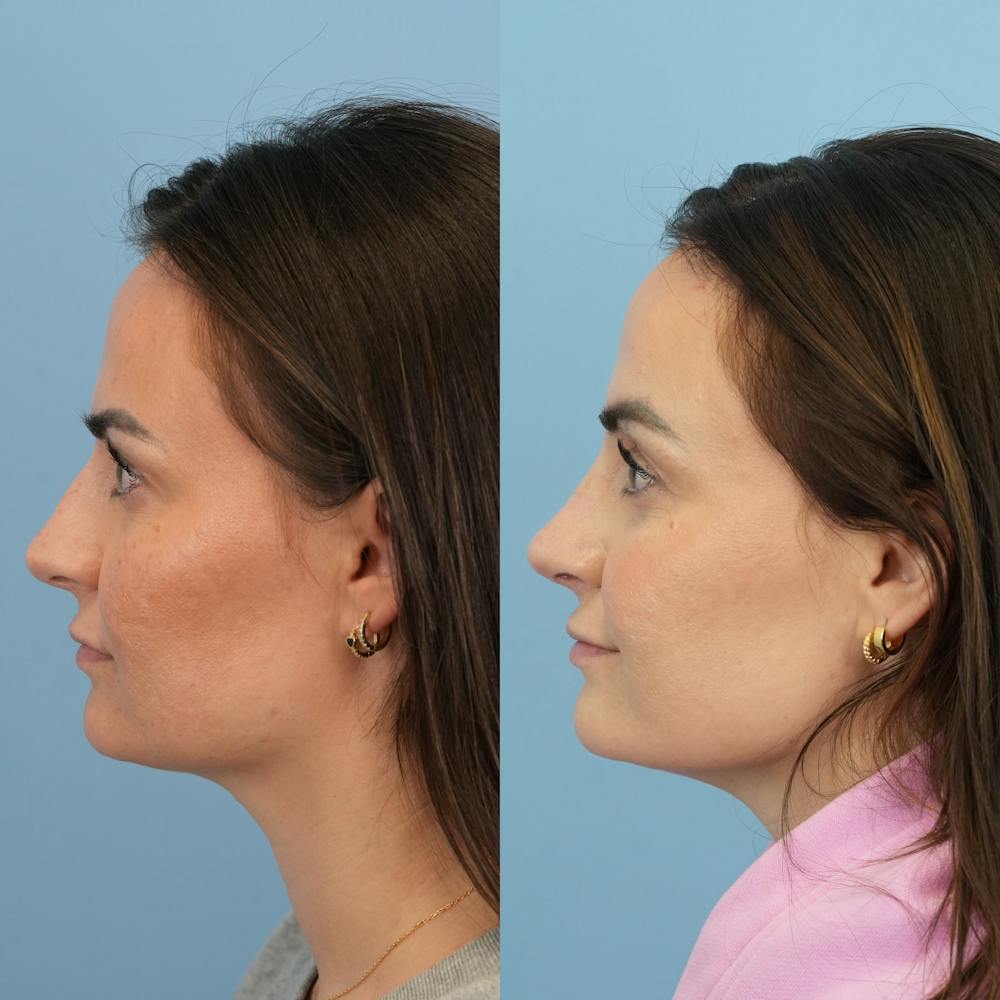 Rhinoplasty Before & After Gallery - Patient 429472 - Image 6