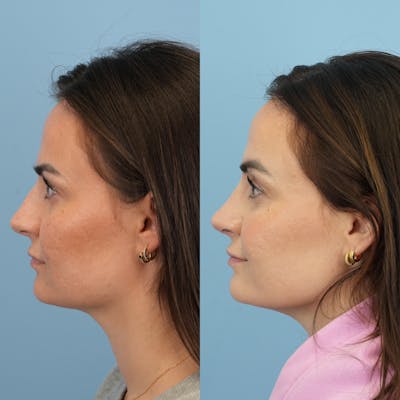 Rhinoplasty Before & After Gallery - Patient 429472 - Image 6