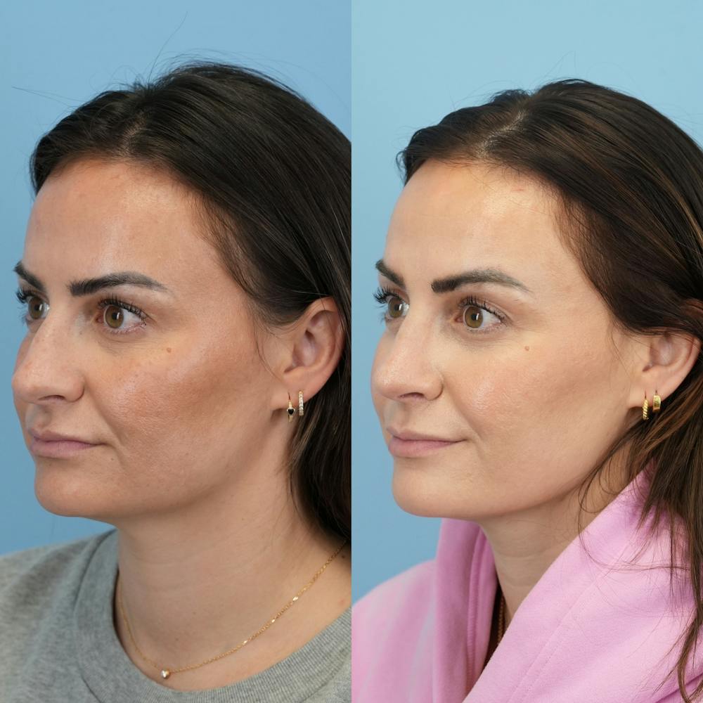 Rhinoplasty Before & After Gallery - Patient 429472 - Image 5