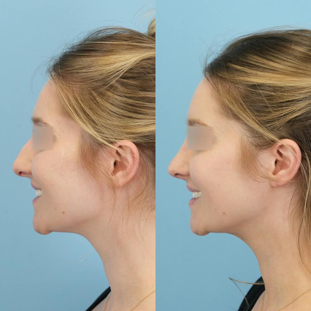Rhinoplasty Before & After Gallery - Patient 191140 - Image 5