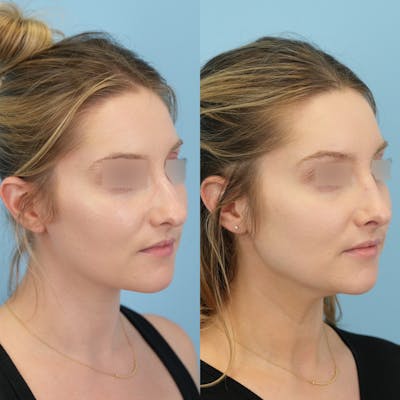 Rhinoplasty Before & After Gallery - Patient 191140 - Image 2