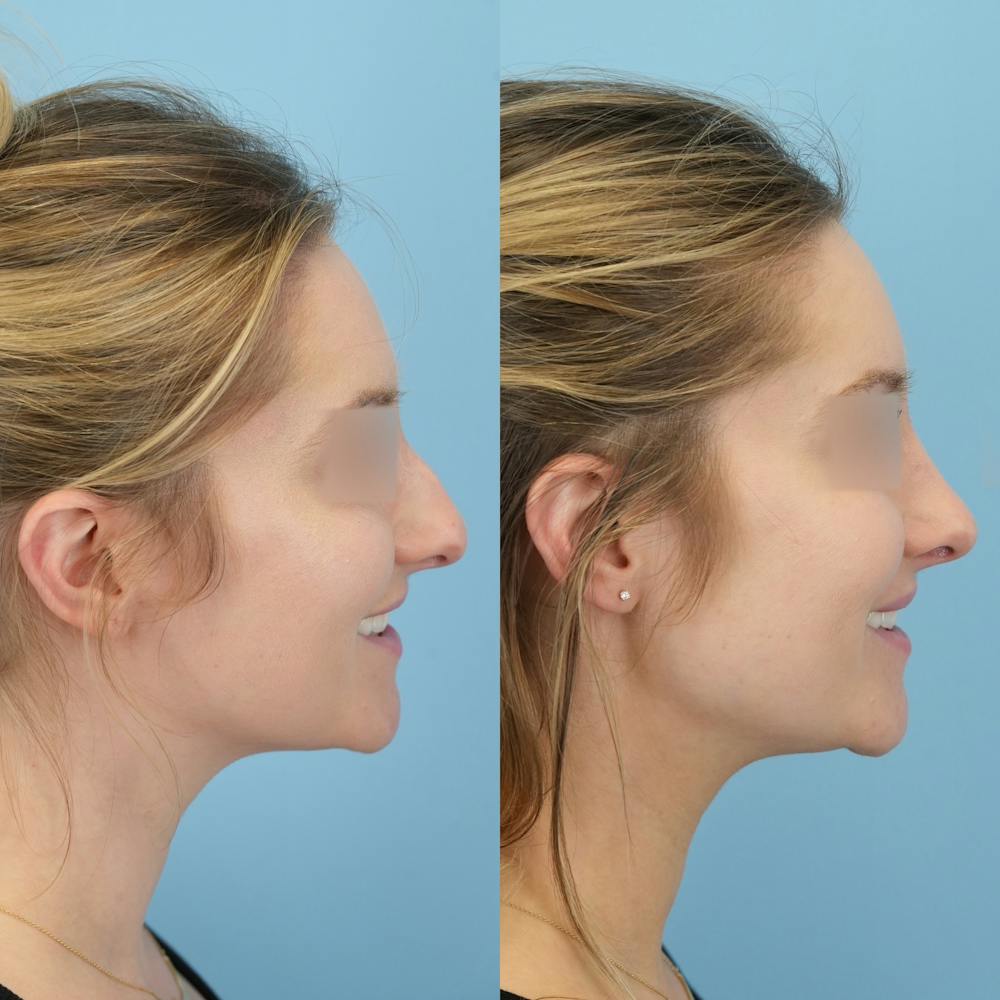 Rhinoplasty Before & After Gallery - Patient 191140 - Image 4